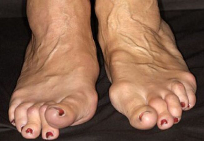 Finalización da osteoartrite