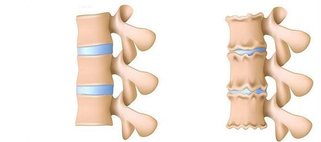 Que é a osteocondrose