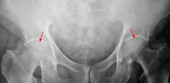 Imaxe coksartrosa de dobre cara da fenda común, esclerose das superficies articulares
