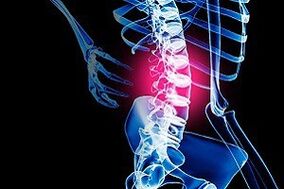 Osteocondrose da columna lumbar