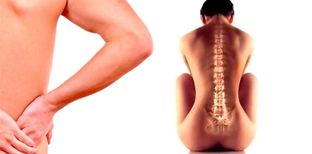 Dor lumbar debido á osteocondrose