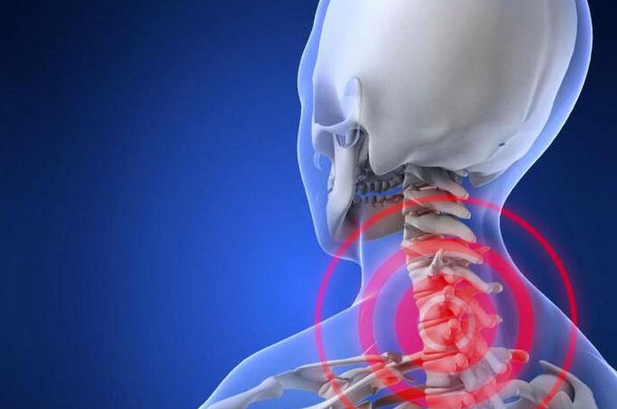 A dor punzante no pescozo é un síntoma precoz da osteocondrose cervical